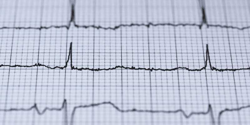 ECG Hartritme