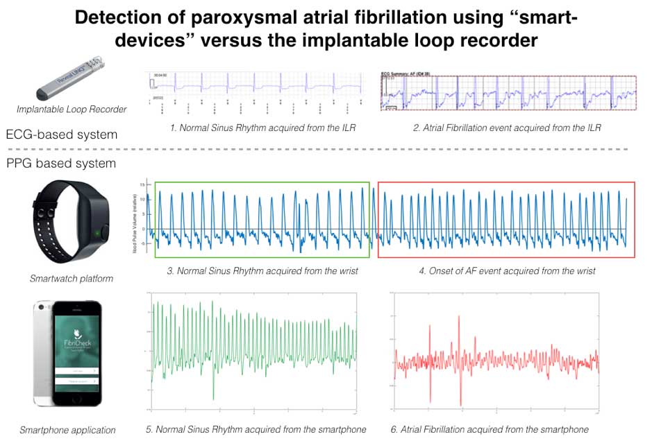 Atrial fibrillation paroxysmal Atrial Fibrillation—How