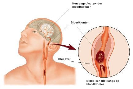 Beroerte is een van de meest voorkomende neurologische aandoeningen in Nederland.